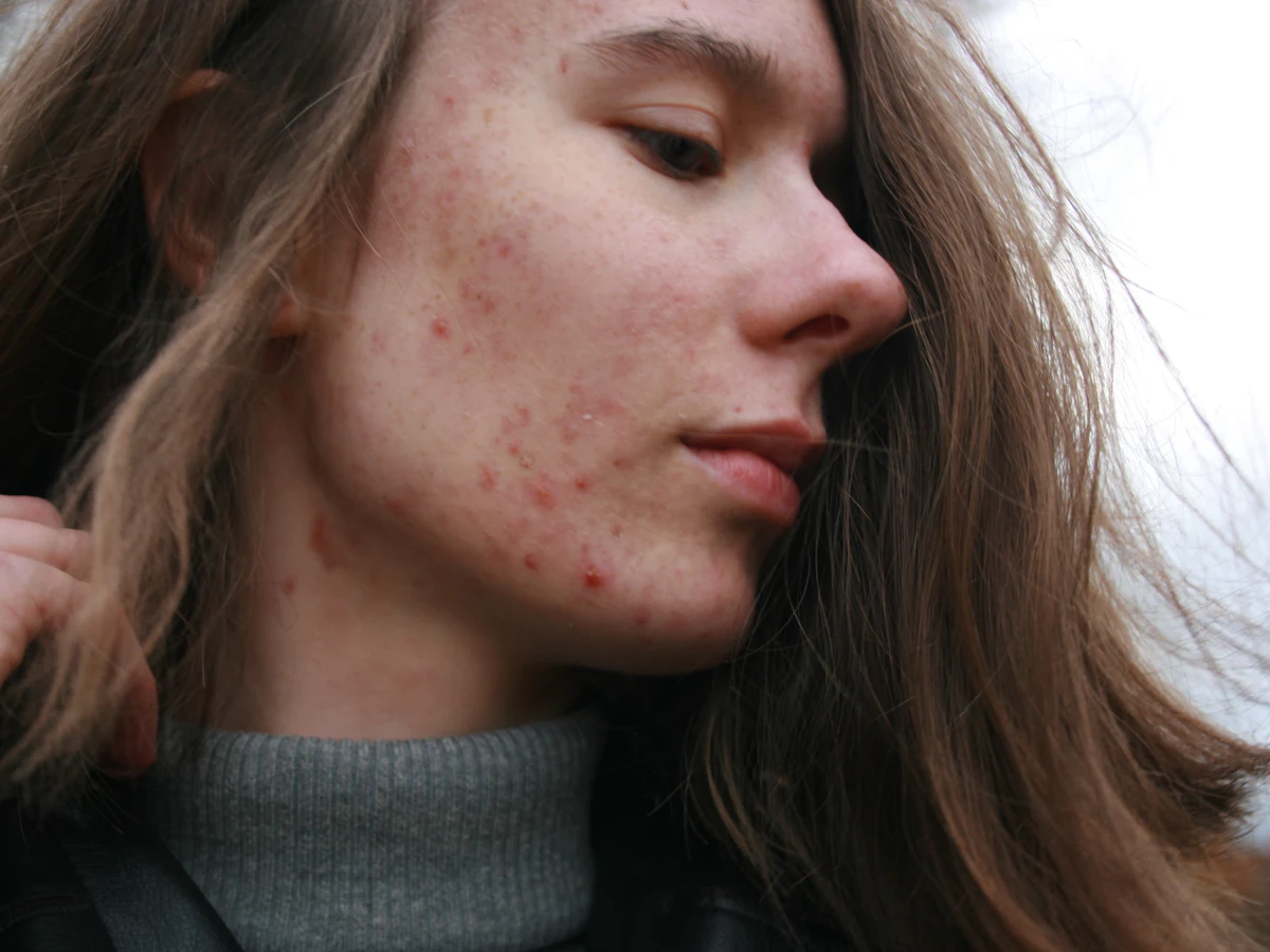 Profile of a woman with acne-prone skin